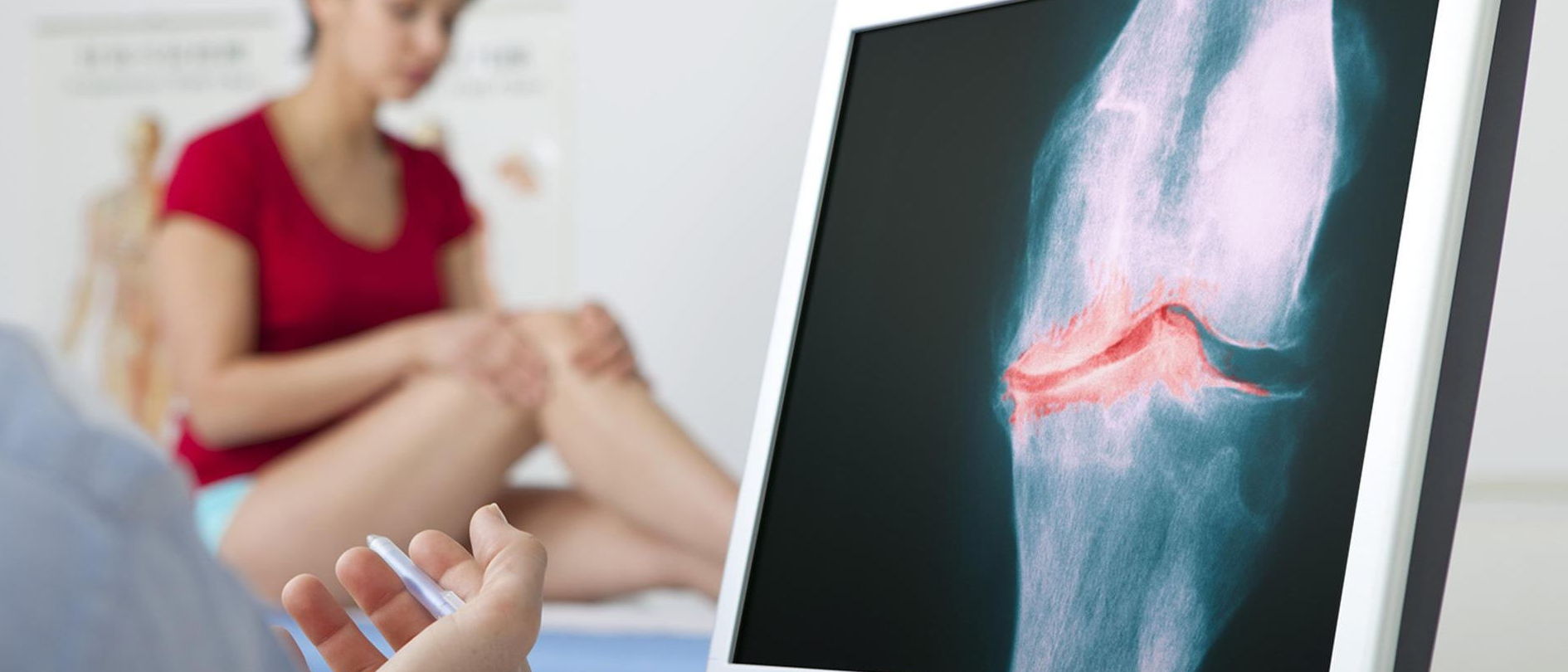 Arthrose, Röntgenbild